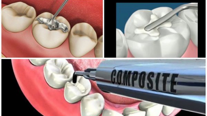 Trám răng bằng Composite hay GIC – Loại nào phù hợp với bạn?