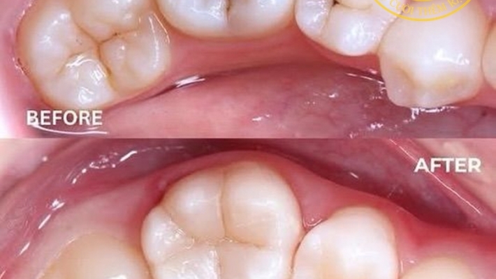 Trám răng thẩm mỹ bằng Composite – Khôi phục răng sâu, giữ nét tự nhiên