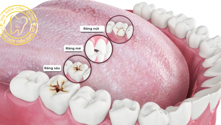 Chữa sâu răng bằng trám Composite: Quy trình và chi phí mới nhất