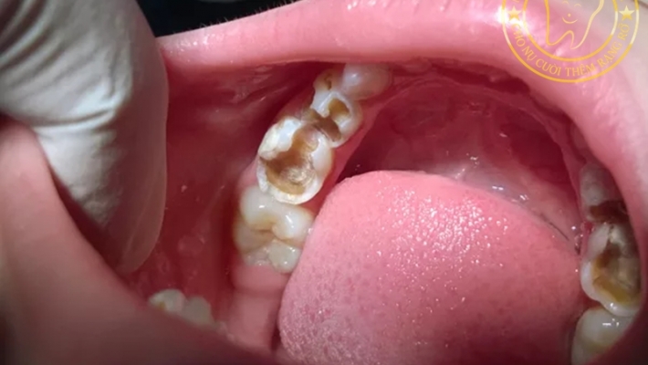 Trám răng sữa cho trẻ: Có cần thiết không và khi nào nên thực hiện?