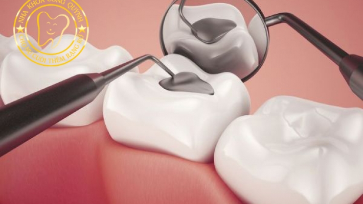 Các câu hỏi thường gặp về trám răng?