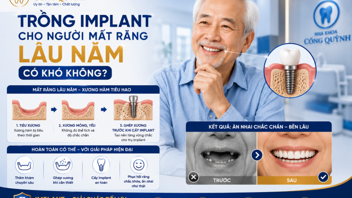 Trồng Implant cho người mất răng lâu năm có khó không?