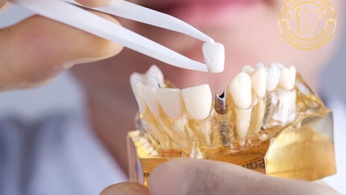Cấy ghép Implant phù hợp với những ai? Dấu hiệu bạn nên trồng răng ngay
