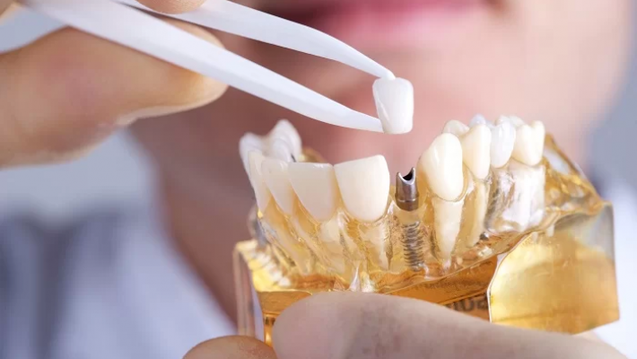 Bảo dưỡng Implant định kỳ tại TP.HCM – Bí quyết duy trì kết quả lâu dài