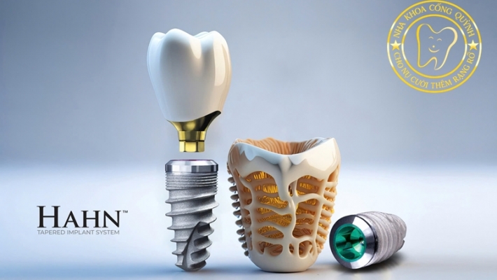 Chi phí cấy ghép Implant tại TP.HCM – Cập nhật mới nhất