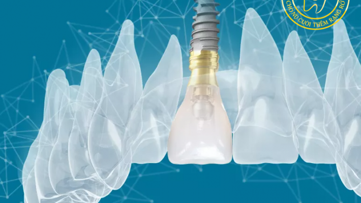 Implant loại nào tốt? So sánh Implant Thụy Sĩ – Pháp – Mỹ