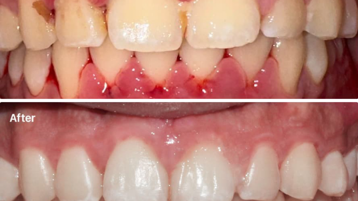 Điều trị viêm nha chu – Giữ nướu khỏe mạnh, bảo vệ răng lâu dài