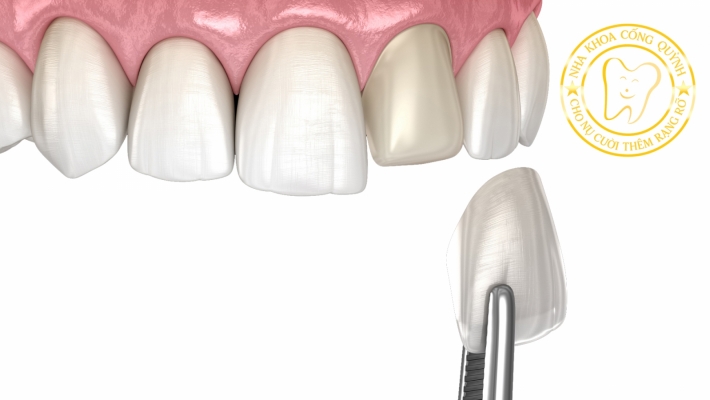 Mặt dán Veneer sứ là gì?