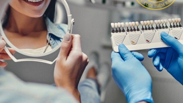 Các câu hỏi thường gặp về Veneer?