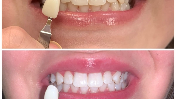 Bọc răng sứ không cần mài nhiều – Giải pháp Veneer là gì?