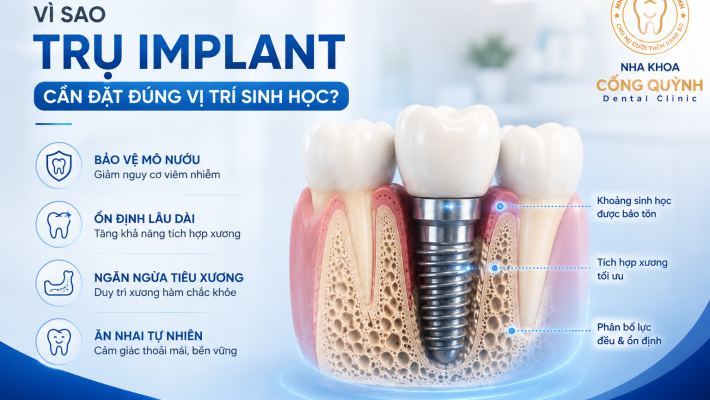 Vì sao trụ Implant cần đặt đúng vị trí sinh học?