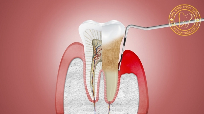 CÁC CÂU HỎI THƯỜNG GẶP VỀ BỆNH NHA CHU