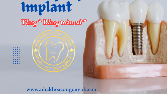 Implant chuẩn quốc tế – lựa chọn hàng đầu của khách Việt Kiều