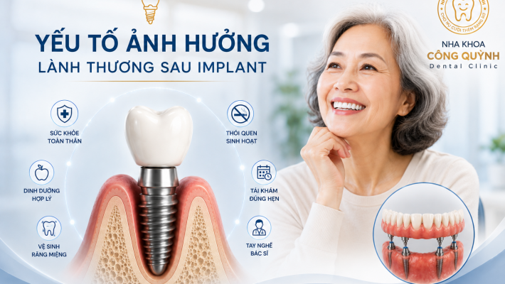 Những yếu tố ảnh hưởng đến quá trình lành thương sau Implant