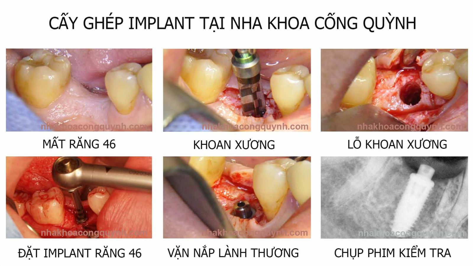 NHA KHOA CỐNG QUỲNH